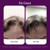 سرم ضد ریزش دکتر گروت Dr.Groot (ضخیمکننده قوی مو)